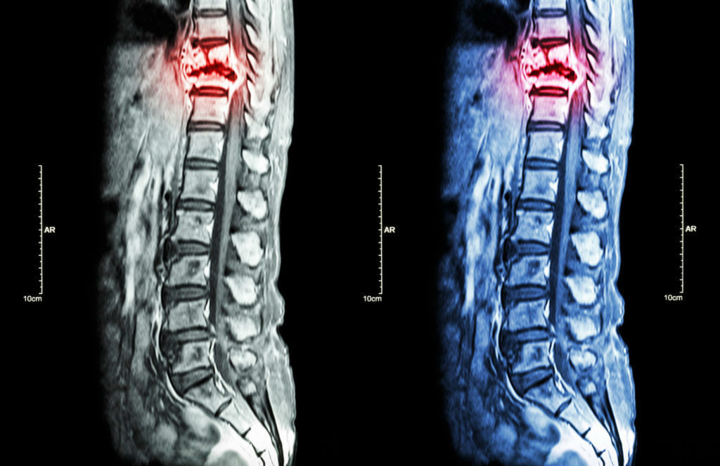 muscle synergy spinal cord injury